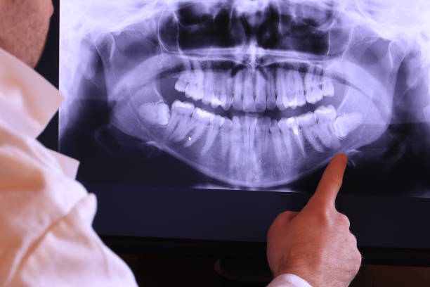 Best Knocked-Out Tooth (Avulsed Tooth) Treatment in Flemingsburg, KY